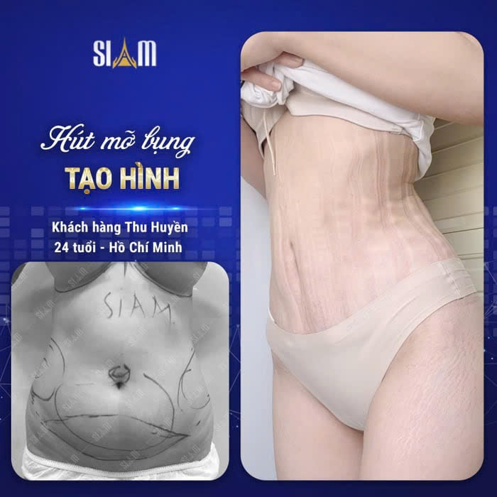 An Kelly's Beauty Spa | Hút Mỡ Bụng Uy Tín Gò Vấp